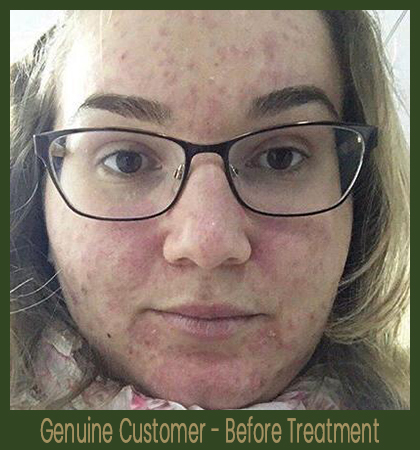 EOS Acne Treatment - Before